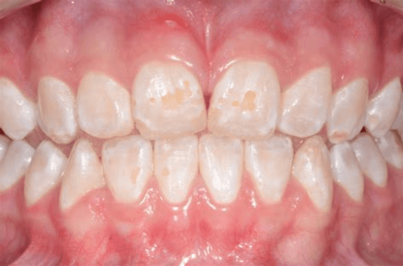 hipoplasia