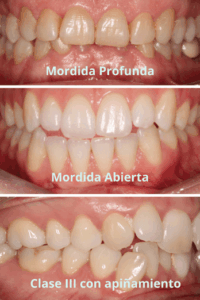 maloclusión dental
